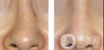 歪鼻矯正多少錢,歪鼻矯正注意事項(xiàng)