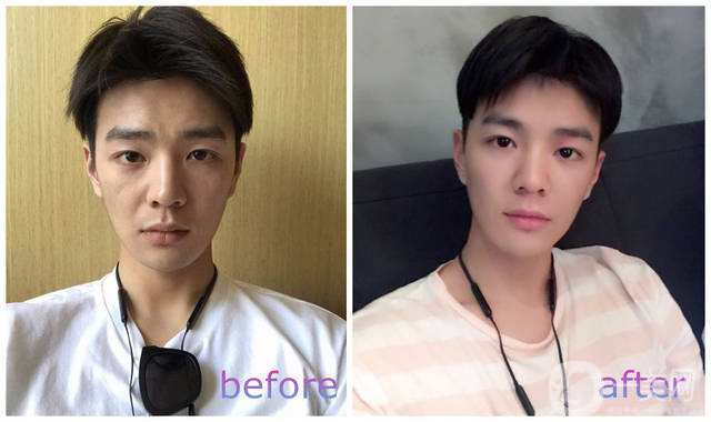 自體脂肪可以填充淚溝嗎？手術(shù)*果好不好？