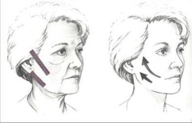 熱瑪吉除皺價格是多少錢 熱瑪吉*果怎么樣