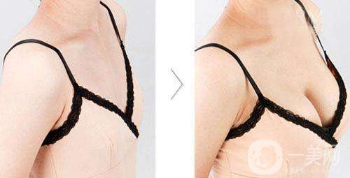 假體豐胸多久才不會硬 多久會變軟？