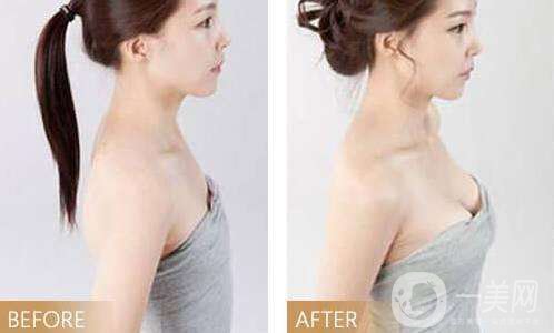 假體豐胸術(shù)前準(zhǔn)備 假體隆胸材料有哪些