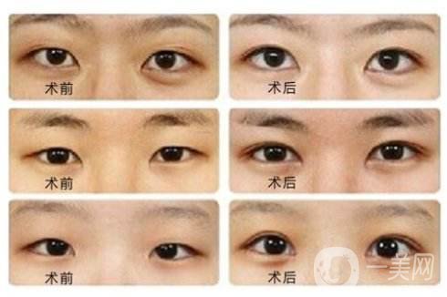 雙眼皮開(kāi)眼角*嗎 開(kāi)眼角要恢復(fù)多久