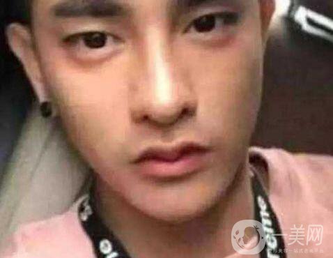 小伙整容數(shù)十次，只為一張韓星臉