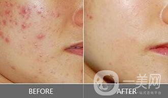 像素激光祛痘坑*果,像素激光祛痘坑術(shù)后護(hù)理