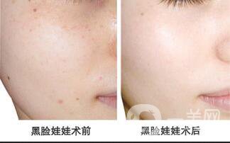 鐳射黑臉娃娃,鐳射黑臉娃娃*果,鐳射黑臉娃娃價(jià)格