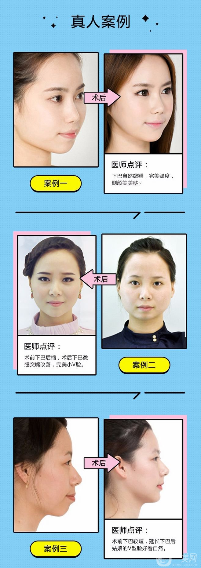 墊下巴都有哪些方式呢？墊下巴前后圖