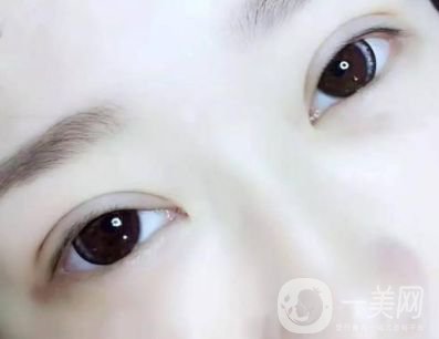 生物焊接雙眼皮手術 割雙眼皮的方法