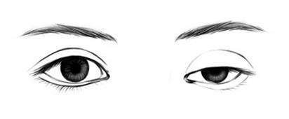 焊接雙眼皮怎么樣 焊接雙眼皮手術(shù)*果怎么樣