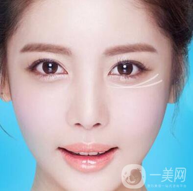 注射去皺后時間久了皺紋會變得更糟嗎？