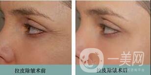 拉皮手術費用,拉皮多少錢