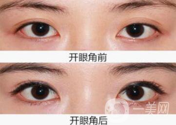 開眼角注意事項(xiàng),開眼角