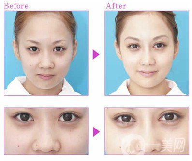 鼻頭縮小手術(shù)圖