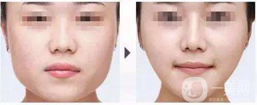 改臉型手術(shù)多少錢 改臉型手術(shù)危險(xiǎn)嗎