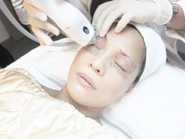 面部電波拉皮保持多久 電波拉皮除皺嗎