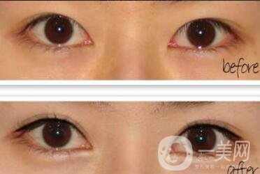 什么人適合開(kāi)眼角,開(kāi)眼角注意什么