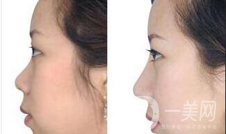 深圳縮鼻頭多少錢,縮鼻頭價格