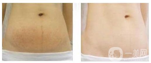 有妊娠紋怎么辦 激光對(duì)于去于妊娠紋的*果