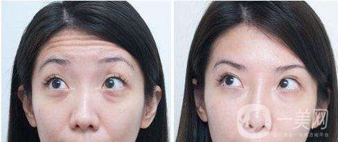 去抬頭紋要多少錢 去抬頭紋的手術方法