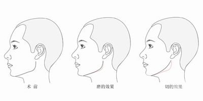 削骨手術(shù)危險嗎 削骨手術(shù)*果怎么樣
