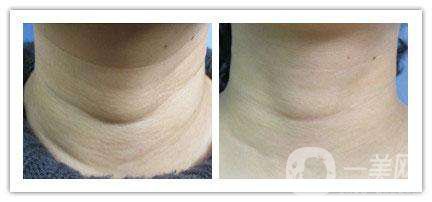 怎么消除頸紋 消除頸紋的方法