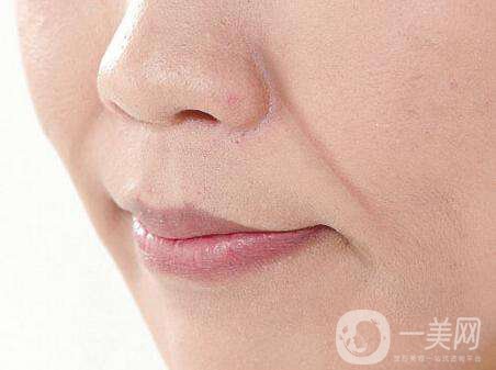 注射伊維蘭除皺多少錢 伊維蘭除皺*果好不好