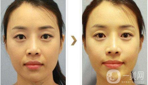 去鼻唇溝多少錢 去鼻唇溝后怎么護理