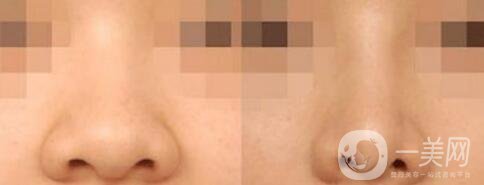 做縮小鼻翼多少錢(qián),鼻翼縮小注意什么