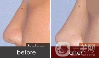 墊鼻尖,墊鼻尖手術(shù)方法