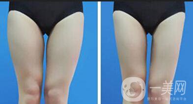 大腿抽脂方法,大腿抽脂注意事項