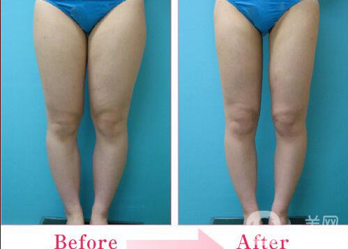 大腿吸脂多少錢,大腿吸脂術后護理