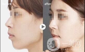 鼻部鼻尖整形多久恢復