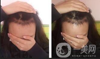 植發(fā)后遺癥