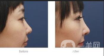 墊鼻梁,墊鼻梁術(shù)后注意什么,隆鼻術(shù)后護理