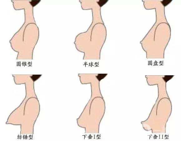 隆胸術(shù)后注意事項(xiàng) 隆胸有副作用嗎