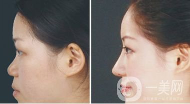 注射隆鼻前后圖 注射隆鼻如何護理