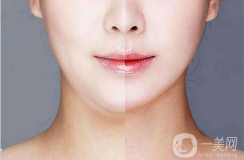 面部吸脂修復手術多少錢 面部吸脂恢復時間