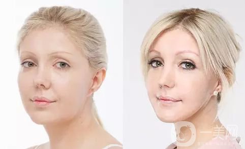 做完磨骨多久可以恢復(fù)自然 *果好不好