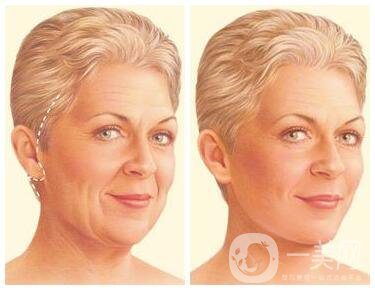 韓國吸血鬼面部提升術(shù)是什么？它有什么不同？