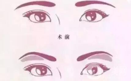 深圳假體豐眉弓手術(shù)費(fèi)用 眉弓手術(shù)*嗎