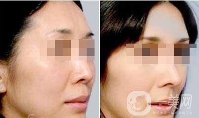 北京自體脂肪豐眉弓多少錢 *果怎么樣？
