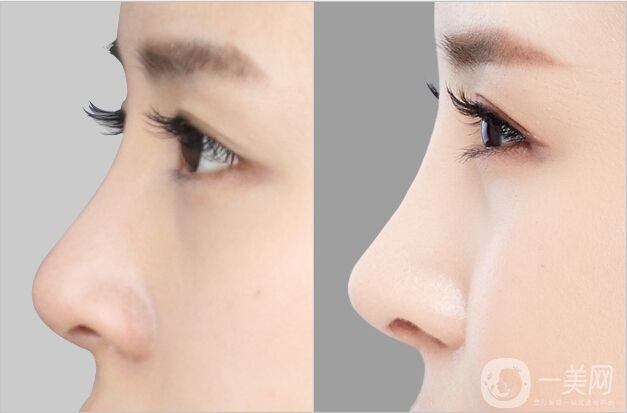 北京鼻根低整形多少錢 隆鼻的方式有哪些