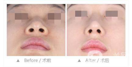 廣東鼻翼寬整形多少錢 鼻翼縮小有哪些方法