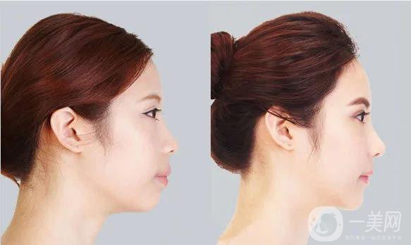 廣東耳軟骨加假體隆鼻價格是多少