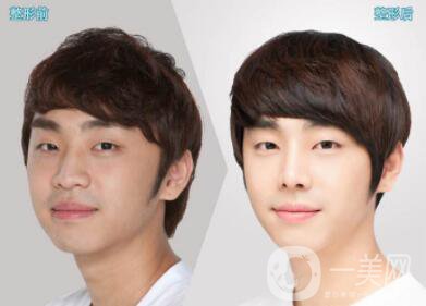 深圳鼻翼縮小多少錢能做 鼻翼縮小方法