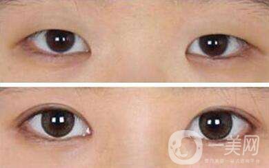 割雙眼皮后注意事項(xiàng) 割雙眼皮術(shù)后護(hù)理