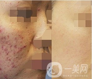 磨皮祛痘坑*果好嗎？去痘坑前后