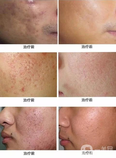 磨皮祛痘坑*果好嗎？去痘坑前后