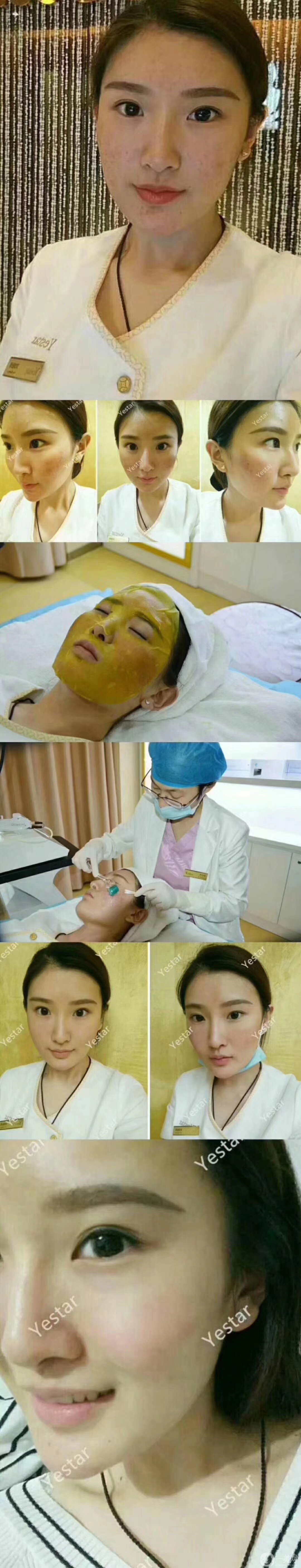 磨皮祛痘坑*果好嗎？去痘坑前后