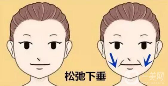 法令紋怎么祛除*果比較好？