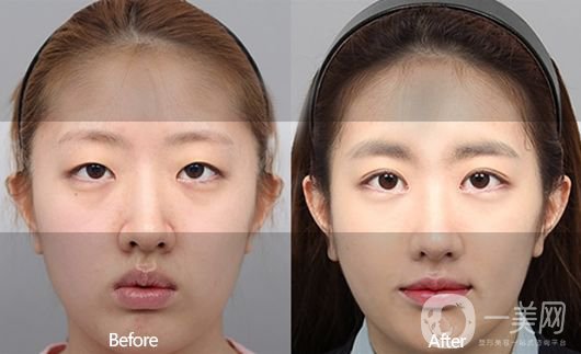 埋線雙眼皮好不好？埋線雙眼皮*果圖